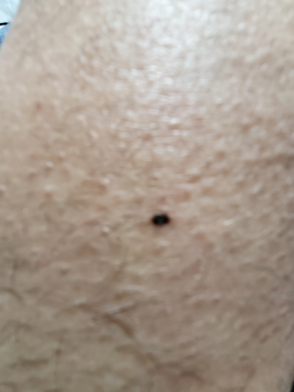 Bestoe 두더지 제거제 솔루션 통증이없는 피부 어두운 반점이 얼굴 사마귀 주근깨 제거 액체모듬 된 색상