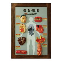 금연교육 흡연예방 전시용품 교육 교구 자료 판넬 흡연질환 입체모형