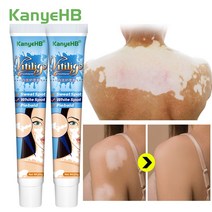 의료 백반증 치료 크림 화이트 스팟 제거 멜라닌 생산 촉진 중국 허브 백반증 피부 건강 관리 A1041 2 개