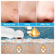 진공 피지제거기 피지 흡입기 여드름 제거제 얼굴 거품 청소기 흡입 블랙 포인트 진공 피지 짜내기 검은 점, 한개옵션0