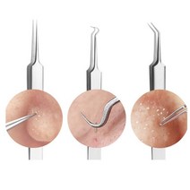 코피지 제거 여드름 압출기 블랙헤드 뽑기, 일자형