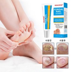 문제성발톱 연고 발톱진균 무좀 손발톱관리 크림 살균