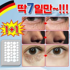 [국내 배송] 1+1/2+2 눈 비립종 제거 패치 눈가 지방 한관종 제거 매립종 입자 제거, 4개, 144매입
