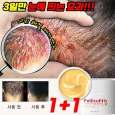 [당일출고] 1+1/2+2/3+3 지루성 두피 피부 가려움증 두피염 여드름 모낭염 건선 연고 두드러기 허브 연고, 3+3