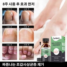 조갑사상균증리페어 에센스 30ML 강력한 네일 리페어 에센스, 30ml*10, 1개