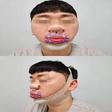 우모나이저 [풀패키지] 업앤드배러 입벌림 코골이 이갈이 방지 밴드 테이프 비강확장기 FULL SET 리뷰 약속X(FULL SET) 1개