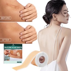 흉터밴드 제왕절개 흉터 화상 수술 흉터 실리콘 젤 패치
