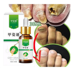 BT 발톱무좀 치료제 무좀약 무좀 케어제 발톱연화 무좀 관리, 1개, 30ml, 30ml