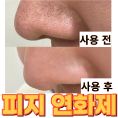 피부과용 피지 연화제 피지녹이는제품 블...