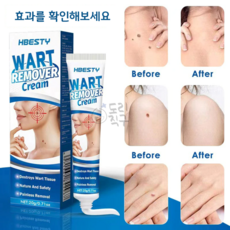 사마귀제거에센스