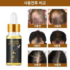 [당일 배송]EELHOE 모발 성장 에센스|모공 소통|탈모 예방|대머리 치료치료 : 원형 탈모증 정수리 탈모증 M자형 탈모증W022, 1개, 20ml