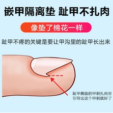 내성발톱교정기와이어