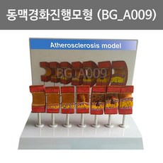 보건몰 동맥경화진행모형 (BG-A009)