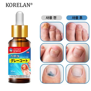 발톱무좀 케어 살균 빠진다 변색 발톱 두꺼워짐 갈라짐, 2개, 30ml