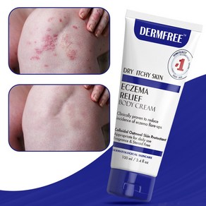 DERMFREE 건선 연고 두드러기 피부 가려움 크림, 1개, 100ml