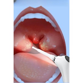 편도결석흡입 편도결석제거기 목똥 입똥 제거 제거기 구강, 1개, C. 디럭스 (강력흡입)