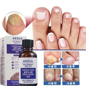 Nail repair Essence 네일 트리트먼트 영양액 트리트먼트 로션 손톱 발톱 전용액