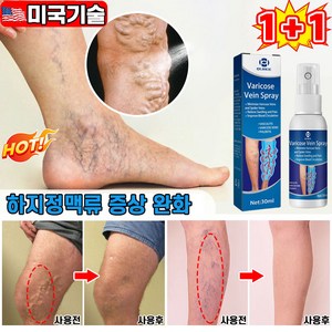 [100% 효과보장] 1/1+1/2+2 하지정맥류 스프레이 다리부종 붓기관리 혈관염 정맥염 연고 정맥류 통증 완화 혈액순환, 2개, 30ml