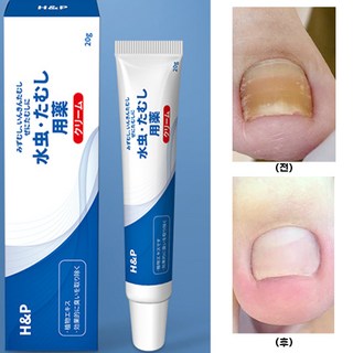 [당일배송] 솔루션 문제성 발톱 손톱 발각질 발각질연화제, 1개, 30ml