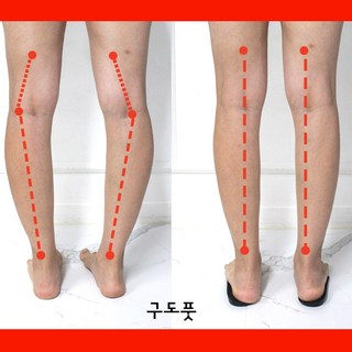 [1+1] 오다리 깔창 x다리 오다리용 팔자걸음 휜다리 걸음걸이 교정 2켤레, 2세트