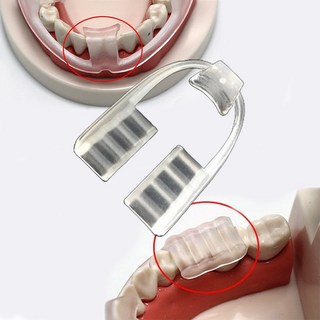 이갈이 방지 치료 보톡스 잘때 어린이 이악물기 수면 마우스 피스 가드 치아보호 이가리 h, 1개