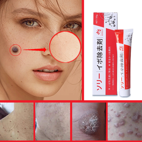 피부 문제 제거 크림 사마귀 퇴치, 30ml, 1개