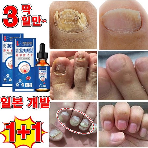 kerasalnail - [일본 개발] 1/1+1 손톱 발톱 무좀 케어 앰플 발톱 영양제 발톱 관리 제거 문제성 발톱/100% 제거/선물 랜덤 증정, 2개, 30ml