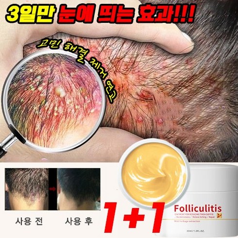 [당일출고] 1+1/2+2/3+3 지루성 두피 피부 가려움증 두피염 여드름 모낭염 건선 연고 두드러기 허브 연고, 3+3