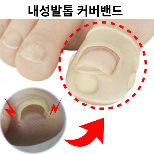 내향성발톱 - 내성발톱 파고드는발톱 문제성발톱 자가치료 교정기, 2개