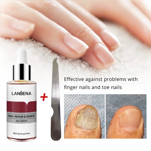 LANBENA 1+1 발톱무좀치료 발톱무좀 진균 리페어에센스 조갑사상균증 손발톱 강화리페어, 15ML
