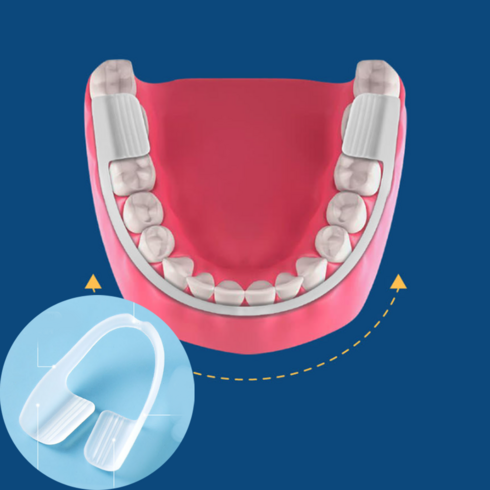 나이트가드고요잠 - 이갈이 마우스피스 방지 수면용 나이트가드 고요잠, 1개
