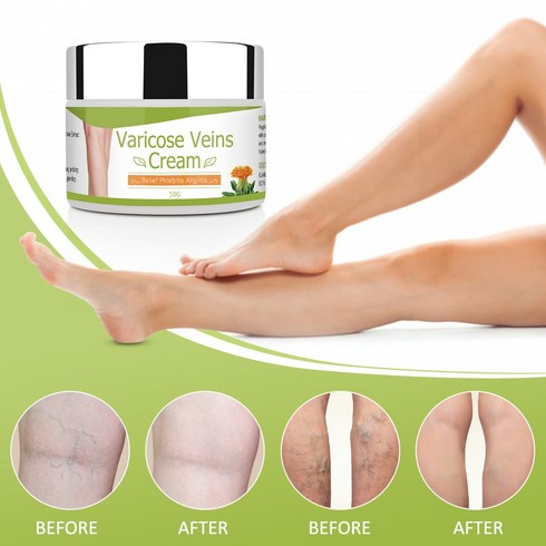 Varicose Veins Cream Natural Treatment Cream For Varicose and Spider Veins Chinese Herbal Medicine R, 1개