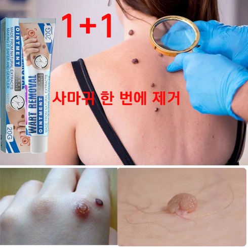 [한국셀러] jaysuing1+1 미국 약 제거약 천연성분 손가락 치료 피부치료, 1개, 20g