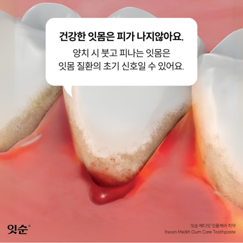잇순 프로폴리스 치약으로 건강한 잇몸, 자신 있는 미소를 되찾으세요!