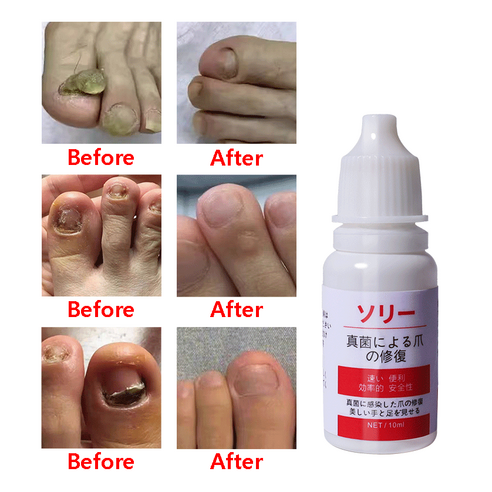 손발톱세럼 발톱연화 발톱 조갑사상균증 살균, 6개, 10ml
