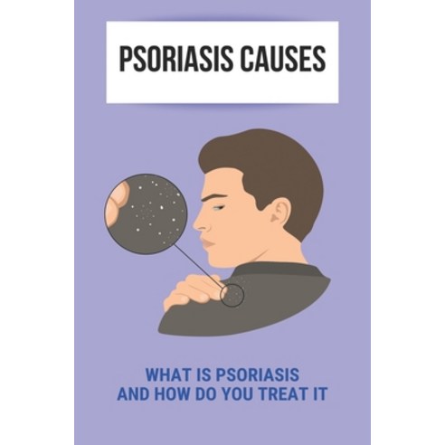 Psoriasis Causes: What Is Psoriasis And How Do You Treat It: Psoriasis Scalp Paperback, Independently Published, English, 9798747455573
