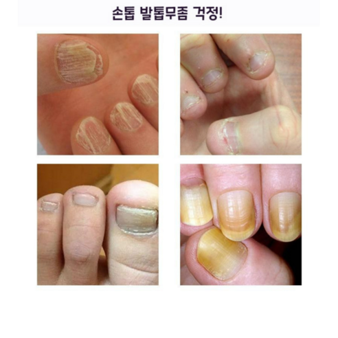 빠르고 효과적인 손톱 진균 치료