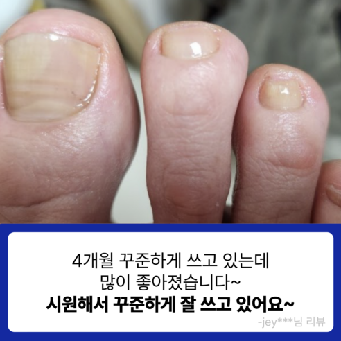 건강한 발톱을 위한 최고의 선택