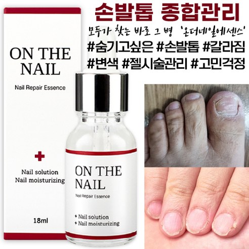 온더네일 에센스 네일 트리트먼트 손발톱 손톱 발톱 리페어 에센스 nail repair nail fungus treatment, 18ml, 1개
