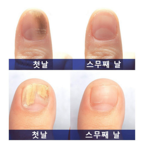 빠르고 효과적인 손톱 진균 치료