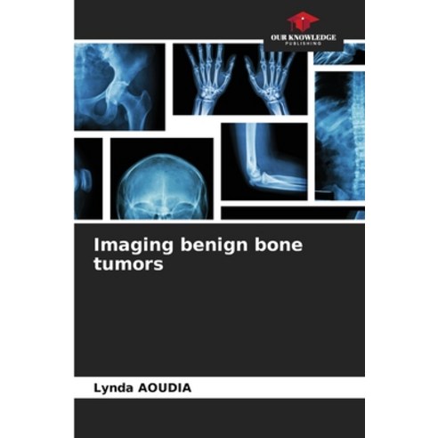 (영문도서) Imaging benign bone tumors Paperback, Our Knowledge Publishing, English, 9786207401031