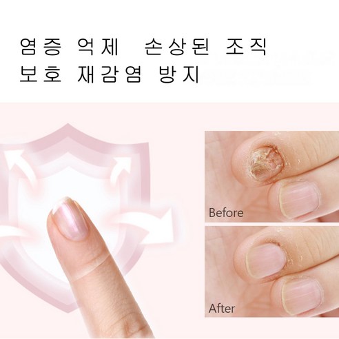 KFILAIR 발톱 무좀 손발톱 케어 크림 풋 리페어 크림 발톱 트러블 솔루션, 2개, 20g