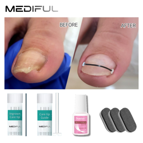 메디플 파고드는 발톱 케어 교정팁 고급형 리뷰 파고드는발톱