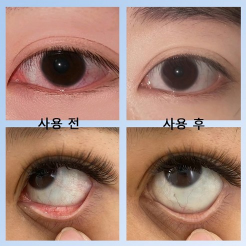 눈 건강, 이제 아이봉으로 시작하세요!