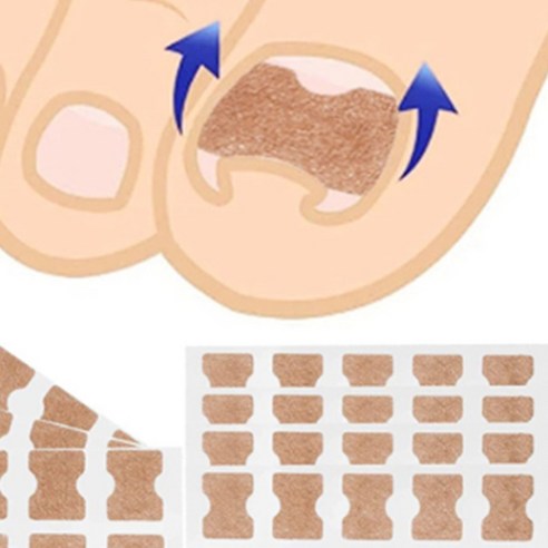 내성발톱테이프 발톱 교정 보호 밴드 10p