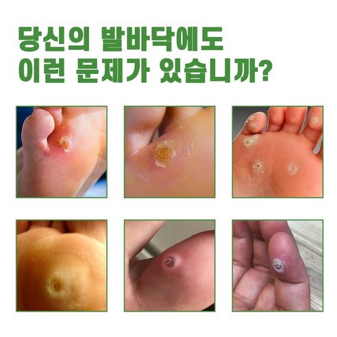 티눈 제거 밴드로 발 건강을 되찾고 활기찬 일상을!