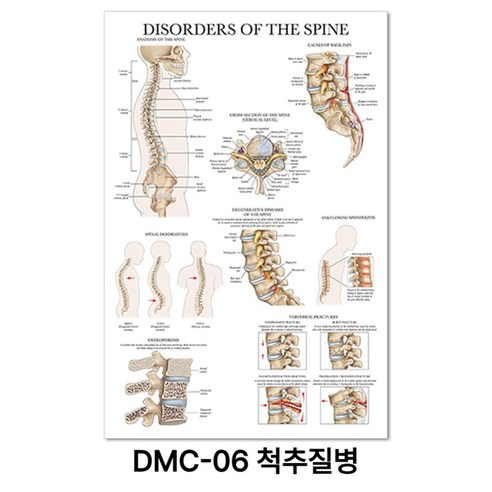 NEW 근육 해부학 포스터, DMC-06 척추질병