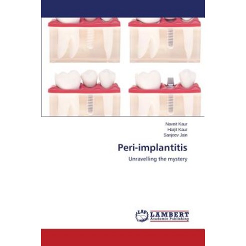 Peri-Implantitis Paperback, LAP Lambert Academic Publishing