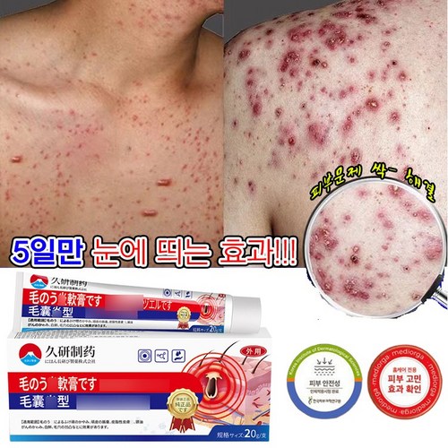 [피부문제99.99%헤결!!!] 일본 기술 모낭 연고 지루피부 피부가려움증 연고 여드름 크림, 1개, 20g