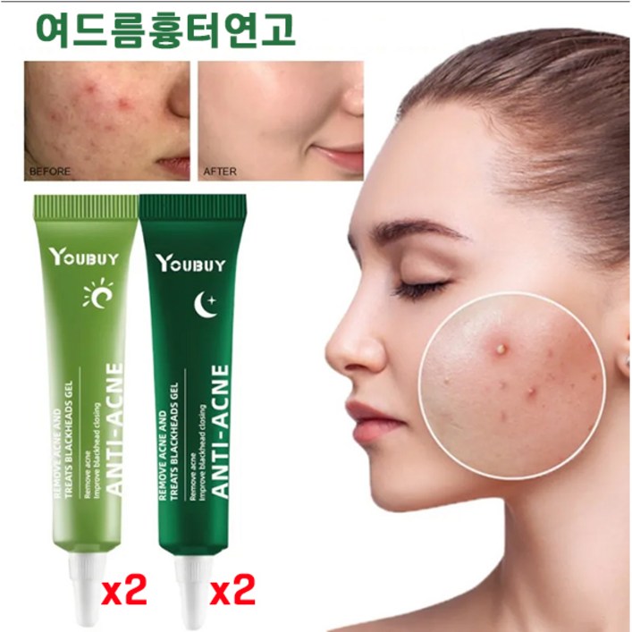 당일배송 일용 야 여드름 연고 여드름 흉터 연고 여드름 흉터 리페어 크림 당일배송 일용 야 여드름 연고 여드름 흉터 연고 여드름 흉터 리페어 크림